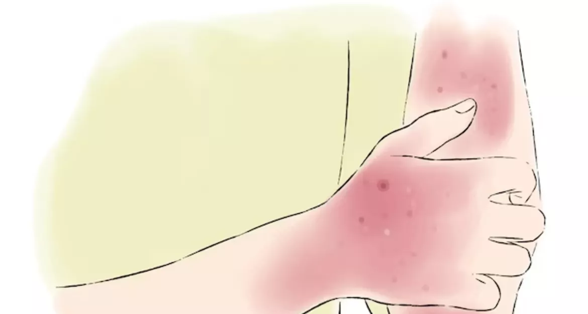 Первая помощь при ожогах: что делать и как избежать осложнений